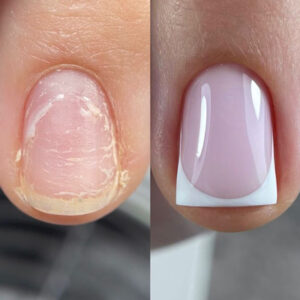 عوارض کاشت ناخن چیست؟