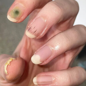 آسیبهای کاشت ناخن برای مشتریان