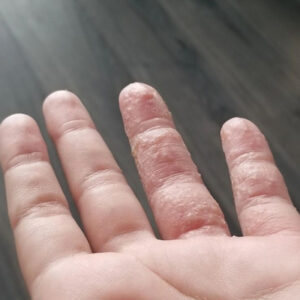 عوارض کاشت ناخن چیست؟