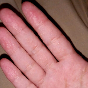 عوارض کاشت ناخن چیست؟