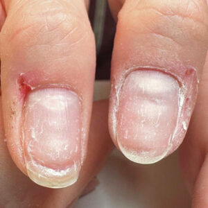 عوارض کاشت ناخن چیست؟